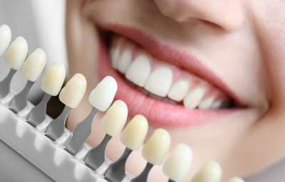 Tooth Coloured Filling