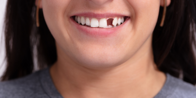 Teeth Replacement