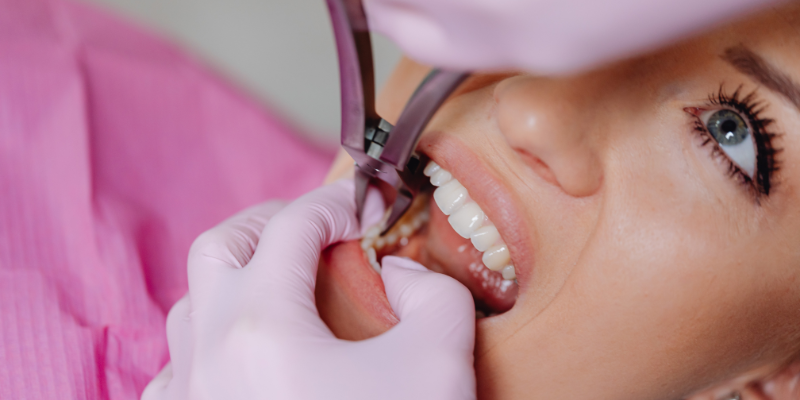Tooth Removal